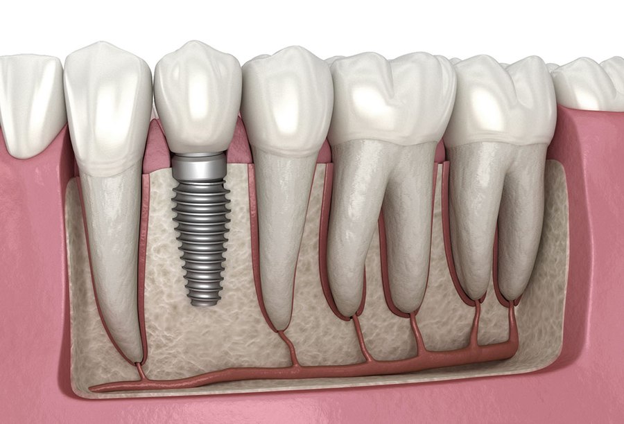 Dental Implants at Smile Design Studio