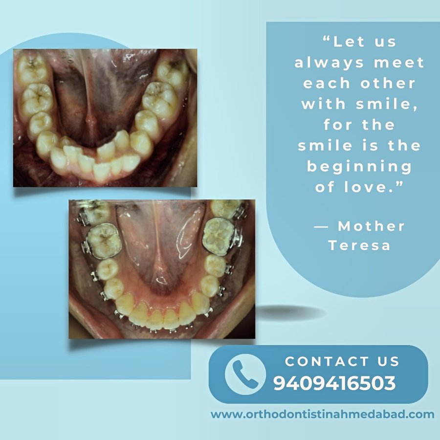 Orthodontic before and after transformation