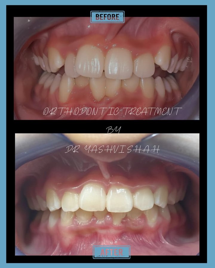 Orthodontic treatment before and after, front teeth alignment