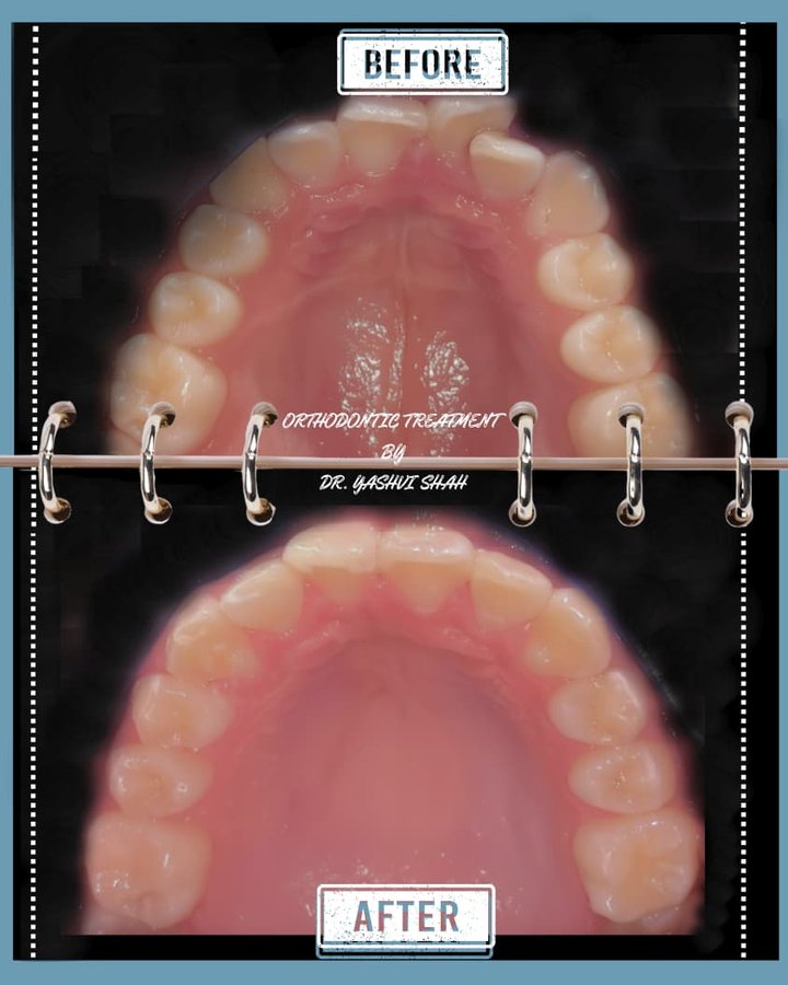 Orthodontic treatment before and after, upper arch braces