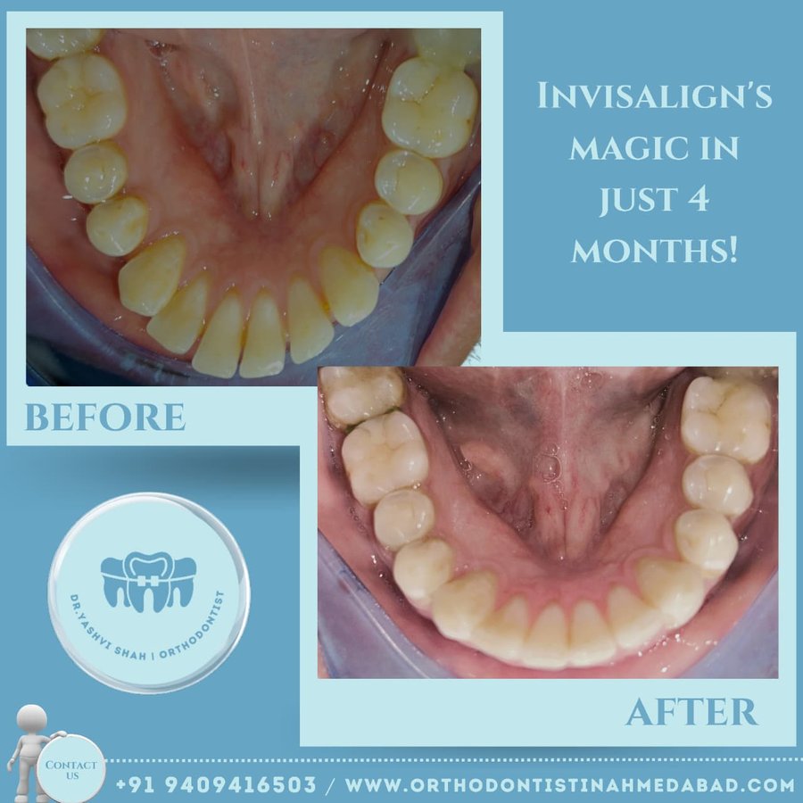 Invisalign transformation in 4 months