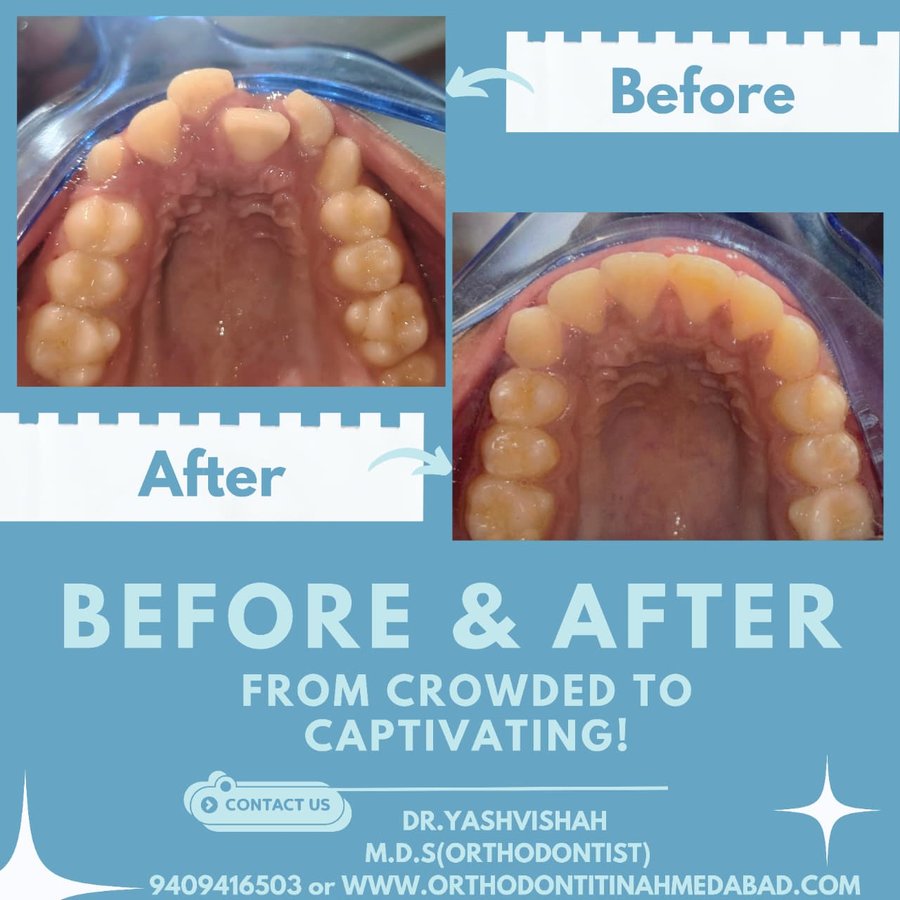 Orthodontic treatment before and after, crowded to captivating