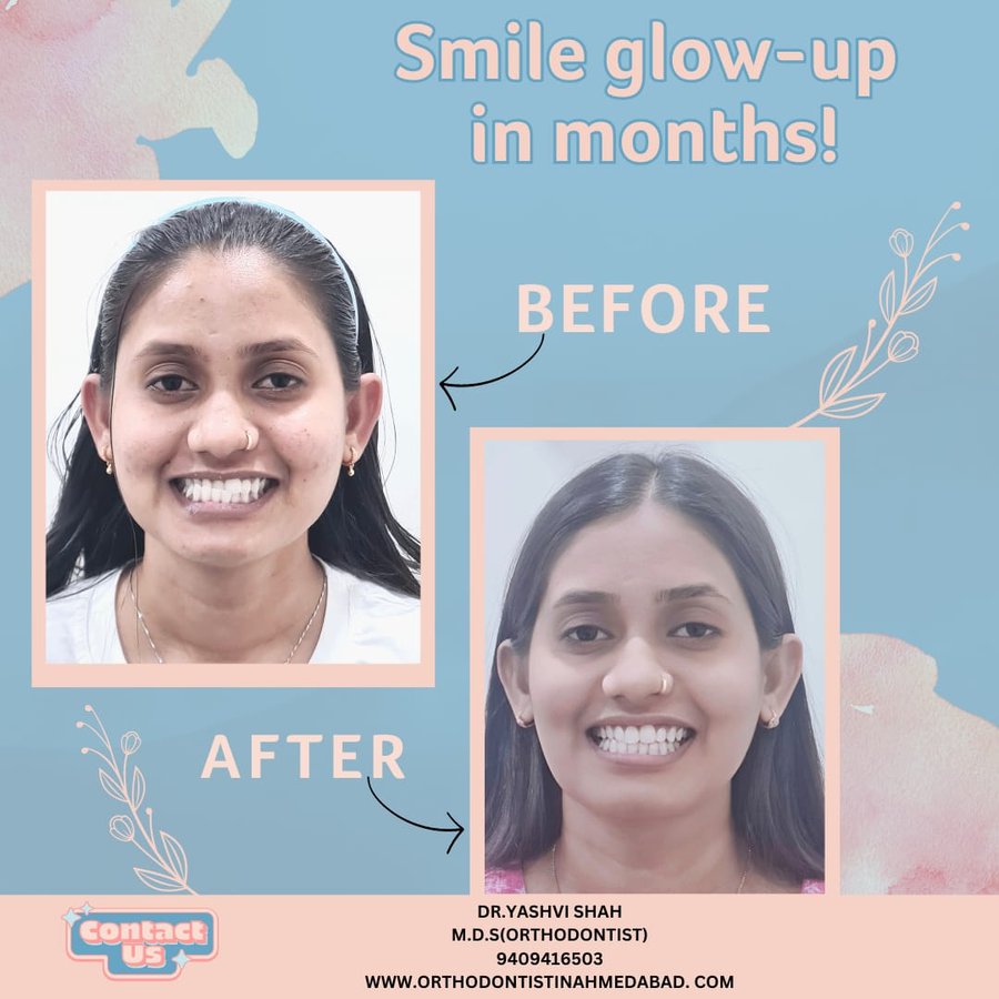 Smile glow-up orthodontic transformation