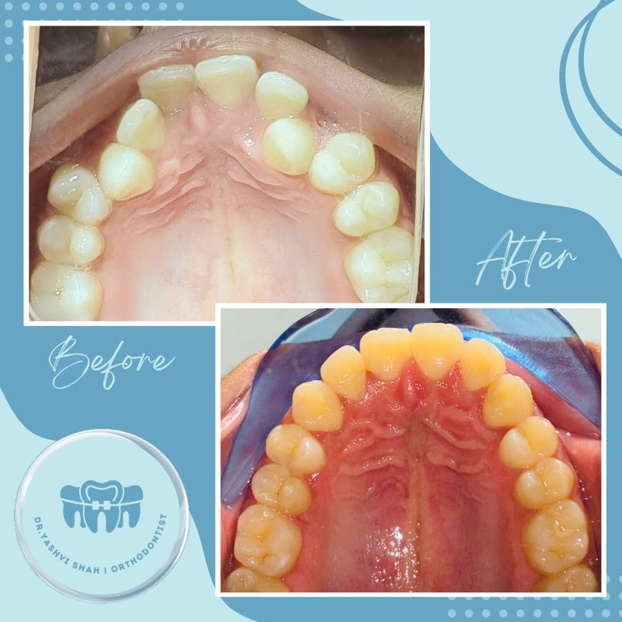 Orthodontic treatment before and after, upper arch