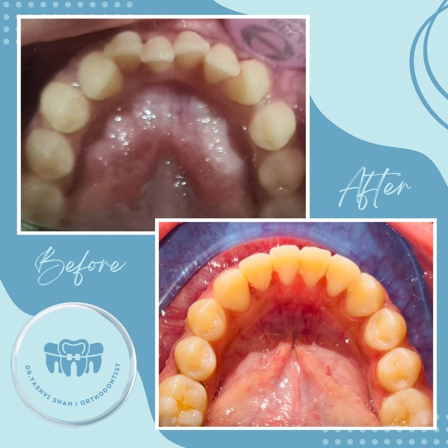Orthodontic treatment before and after, upper arch alignment