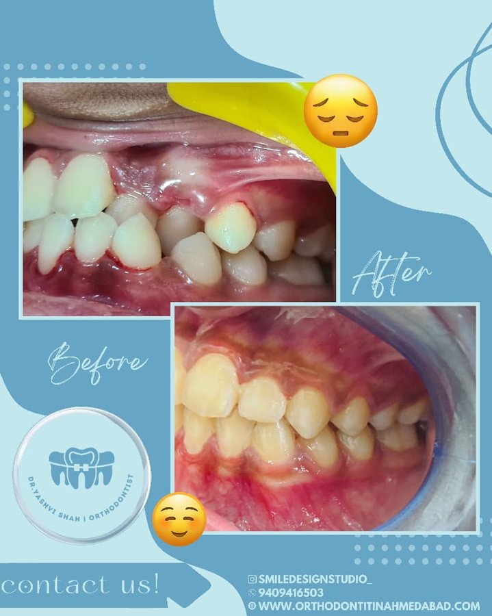 Orthodontic treatment before and after, bite alignment