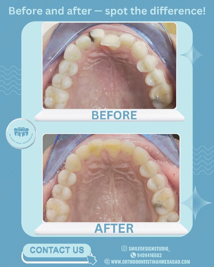 Before and after orthodontic treatment, spot the difference