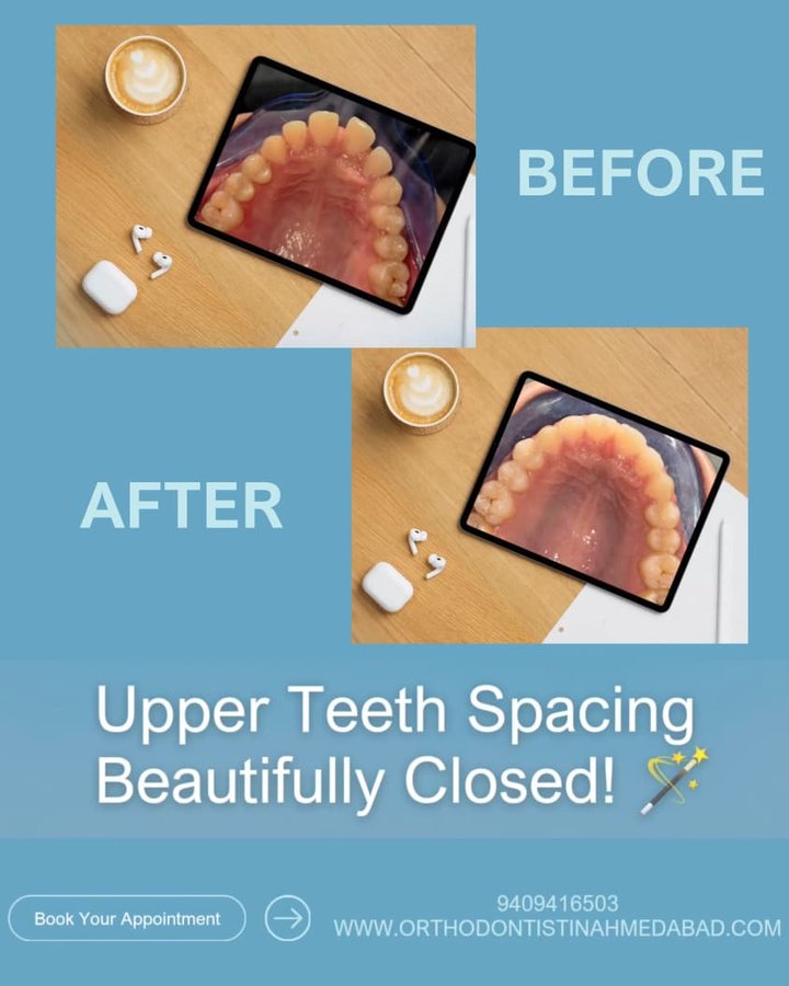 Upper teeth spacing beautifully closed