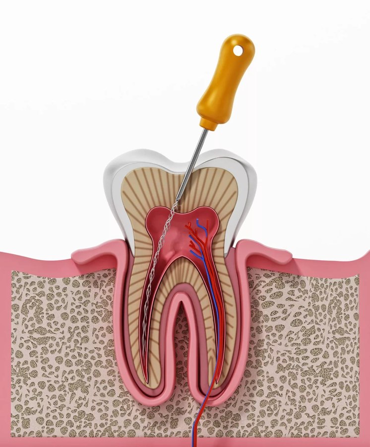 Root Canal Treatment at Smile Design Studio