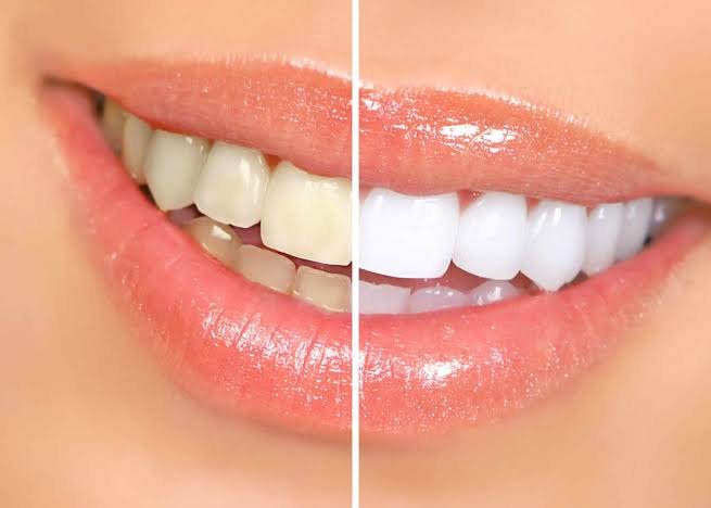 Teeth Whitening at Smile Design Studio
